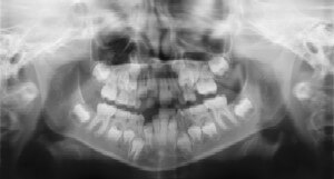 Dental Radiographs (X-Rays) - Pediatric Dentist in Avon, CT
